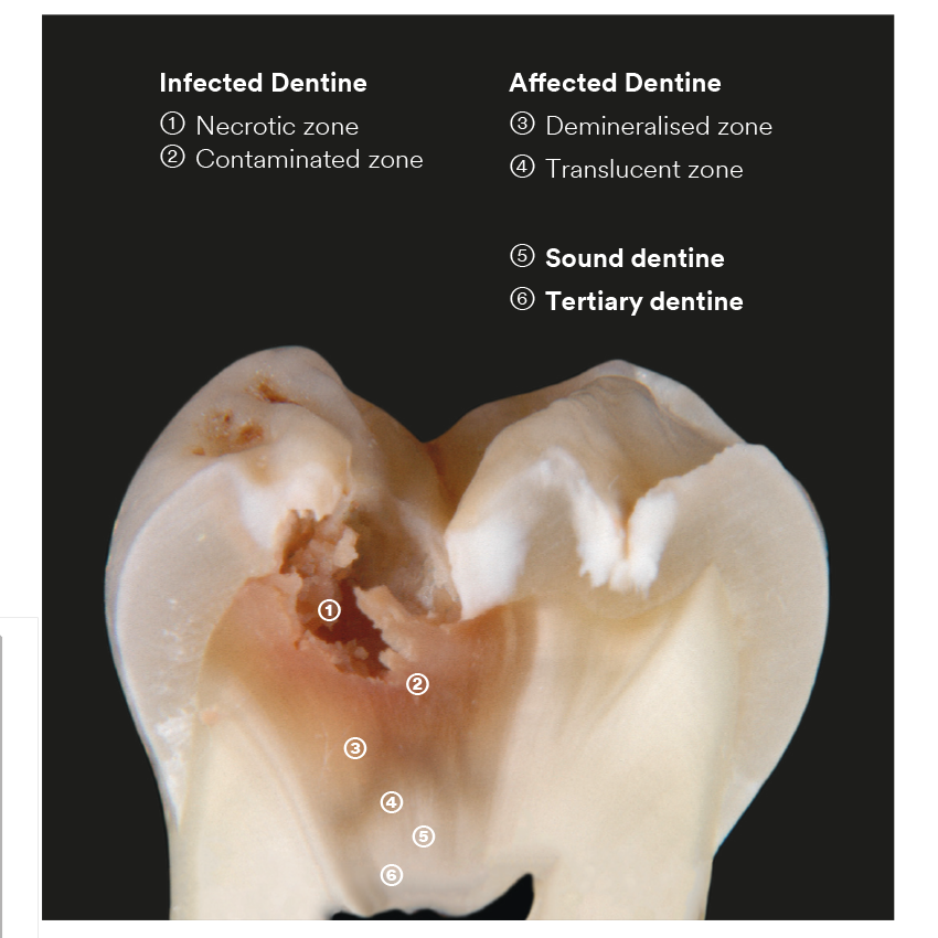 3M_Caries_zones.png