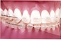 Reverse Curve G4 NiTi Tooth-Coloured .016x.022 Lower