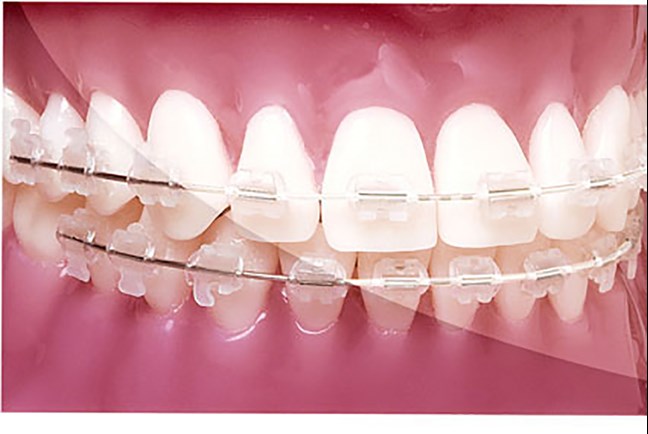 Reverse Curve G4 NiTi Tooth-Coloured .017x.025 Lower