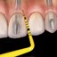 UNC 12 Colorvue Probe Tips