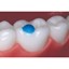 Reliamold Molar Pad Attachment