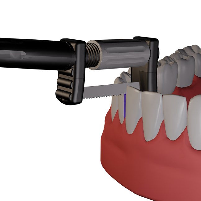 ProxyMate Refills Serrated Saw