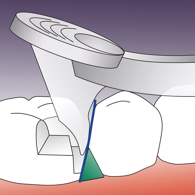 PerForm Proximal Contact Introductory Kit