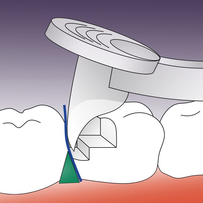 PerForm Proximal Contact Introductory Kit
