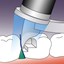 PerForm Proximal Contact Introductory Kit
